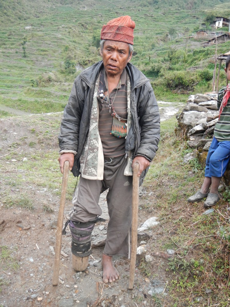 A very poor man in the village of Tipling.  He lost the lower part of his right leg 24 years ago.